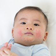 bambino orticaria, bambino con orticaria sul viso